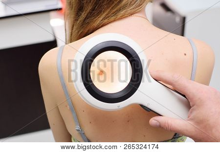 The Doctor Examines The Birthmarks Of The Patient Through A Magnifying Glass