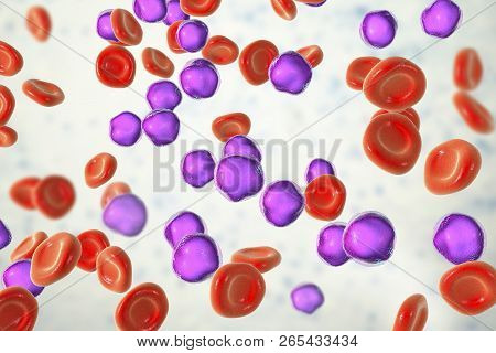 Acute Lymphoblastic Leukemia, Bone Marrow Smear, 3d Illustration