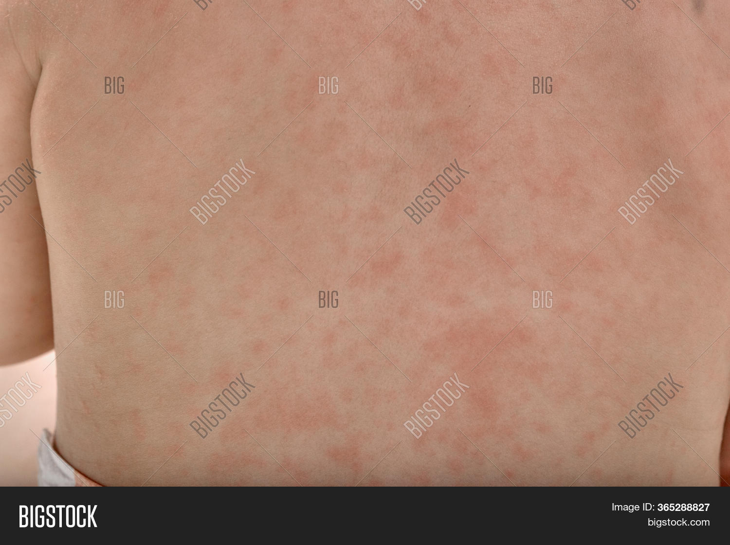 Roseola Rash Viral Image & Photo (Free Trial) Bigstock