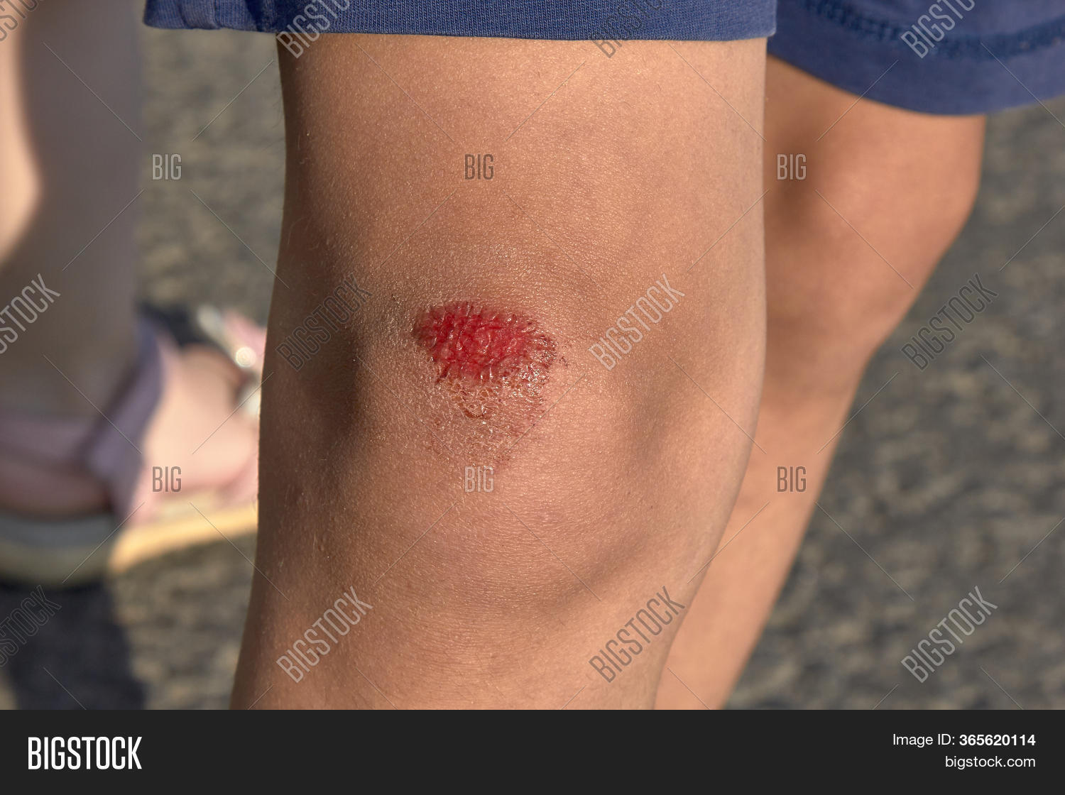 Bruised Wound On Knee Image & Photo (Free Trial) Bigstock