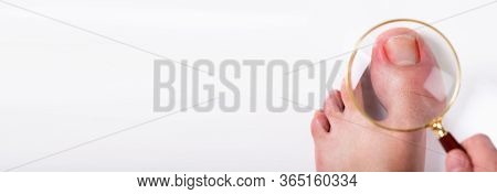Ingrown Toenail. Infected And Sore Nail Problem Magnifying Glass