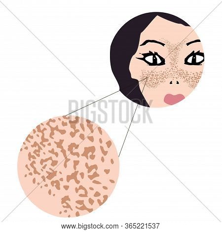 Freckles On The Face. Pigmentation On The Skin. A Pigmented Spot On The Skin Of The Face. Vector Ill