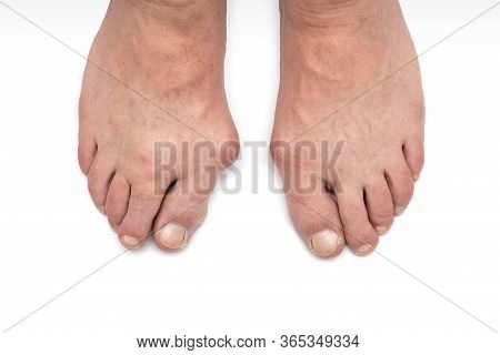Varus Valgus And Hallux Valgus, Bunion On White Background.