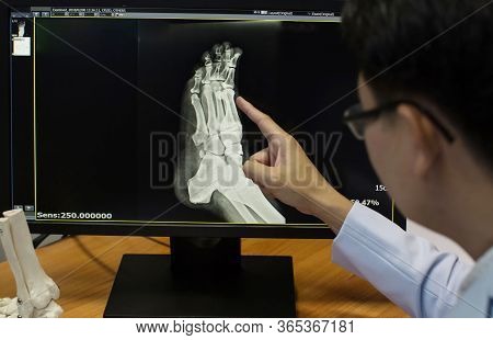 Doctor Pointing On The Knee Problem Point On X-ray Film. X-ray Film Show Skeleton Knee On Film. Surg