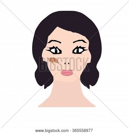 Pigmentation On The Skin. A Pigmented Spot On The Skin Of The Face. Vector Illustration