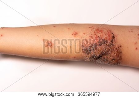 Impetigo On A Child's Arm With White Background