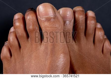 Hammer Toe On The Second Toe Of A Mixed-race Woman In Front Of Black Background. Concept For Medical