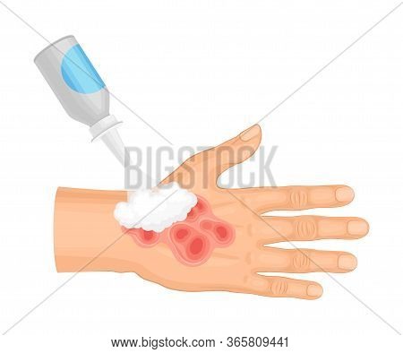 First Aid For Hand With Ambustion Or Burn On The Skin Vector Illustration