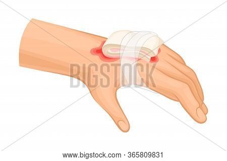 First Aid For Hand With Ambustion Or Burn On The Skin Vector Illustration