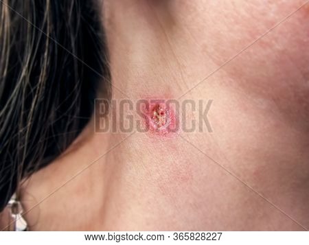 A Wound On A Woman Neck After Burning A Wart, Close-up. Round Painful Hole In Human Skin, Purulent W