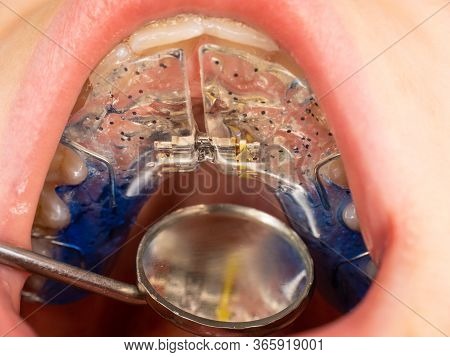 Dentist Check Up Teeth With Expander Brackets Using Dental Tools - Probe And Mirror At The Dental