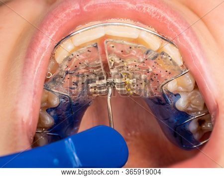 Dentist Work With Braces And Children Mouth With Birth Teeth Deformation. Fix Of Palatal Closing Out