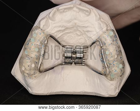 Temporary Used Orthodontic Appliance To Make Young Upper Jaw Wider. Palatal Expander For The Maxilla