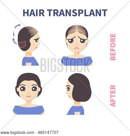 Fue Hair Transplant Treatment Of Alopecia Illustration