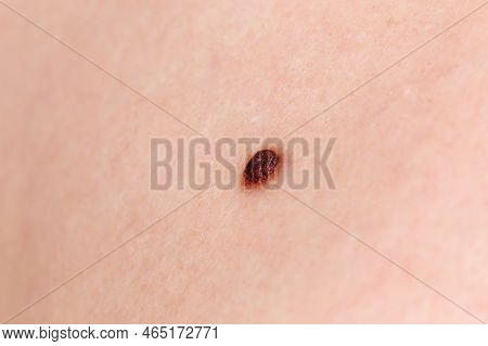 Precancerous Mole - Birthmark Is Potentially Cancerous Melanoma