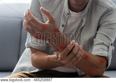Ill Allergic Rash Dermatitis Eczema Skin Of Patient