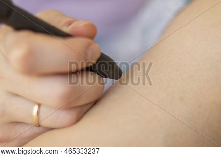 Removing Hair Permanently With A Needle Using An Electroepilator. Removal Of Hair By Electric Shock 