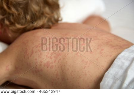 Itchy Red Spots Strewn The Entire Back Of A Sick Child. A Small Child Lies In Bed On His Stomach, Mo