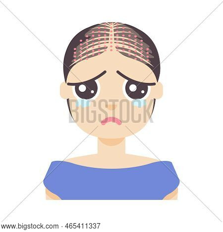 Fue Hair Transplant Treatment Of Alopecia Illustration