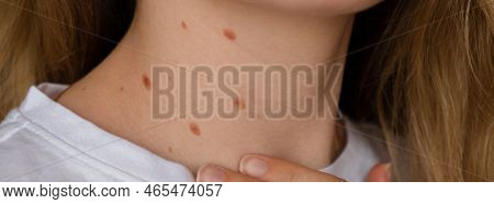 Unrecognizable Woman Showing Her Birthmarks On Neck Skin Close Up Detail Of The Bare Skin Banner Sun