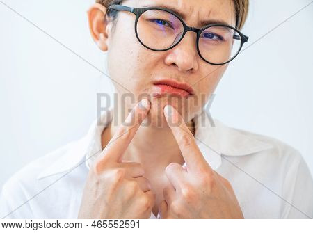 Asian Woman Pointing To Herpes Labialis Occur On Her Lower Lip. Blisters That Break Open And Form Sm
