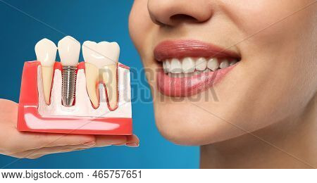 Young Woman With Beautiful Smile And Dentist Holding Educational Model Of Dental Implant On Blue Bac