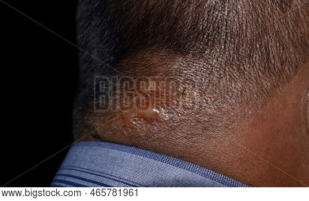Seborrheic Dermatitis At The Nape Of Southeast Asian, Myanmar Adult Male Patient. Right Lateral View