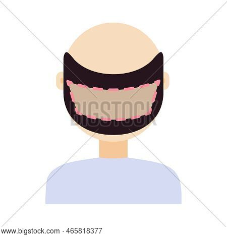 Fue Hair Transplant Treatment Of Alopecia. Back View Of A Man At Surgery. Male Hair Loss Pattern. Me