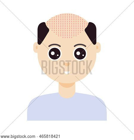 Fue Hair Transplant Treatment Of Alopecia. Front View Of A Man Before Surgery. Male Hair Loss Patter