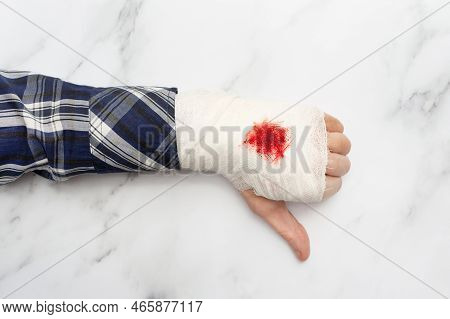 A Man In A Shirt With A Bandaged Hand Shows A Dislike, Holds A Thumbs Down. Top View.