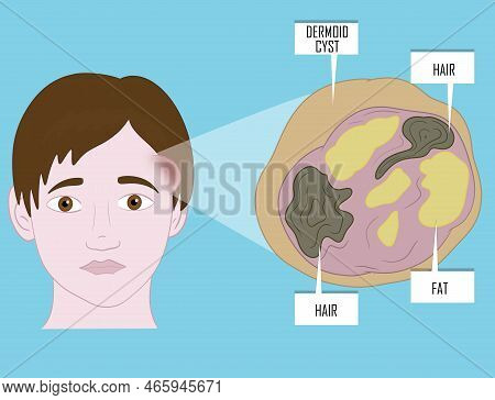 Dermoid Cysts Symptoms On Young Patient Face. Illustration.