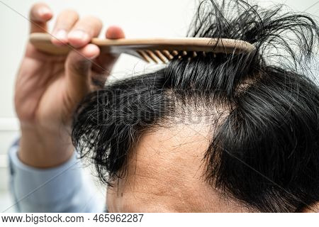Bald In The Middle Head And Begin No Loss Hair Glabrous Of Mature Asian Business Smart Active Office