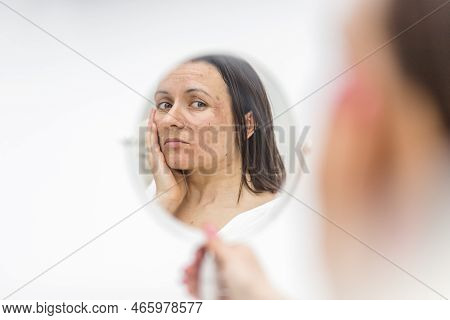 Photo Of Woman Having Skin Problems Looking In The Mirror.