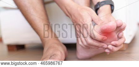 Man Having Bunion Toes Or Blister Due To Wearing Narrow Shoes And Waking Or Running Longtime, Barefo