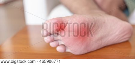 Man Having Bunion Toes Or Blister Due To Wearing Narrow Shoes And Waking Or Running Longtime, Barefo