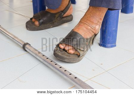 closeup feet of old asian man suffering from leprosy with a cane on the ground
