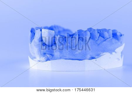 metal-ceramic dental crown is tried on an artificial model