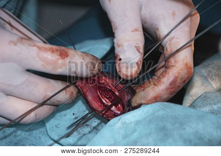 Osteosynthesis With External Fixation (concept Of Surgery).
