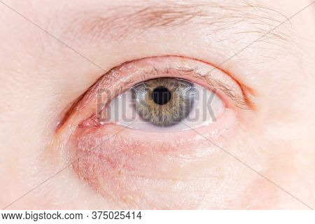 Human Eye With Gray Iris With Small Amounts Of Yellow Color And Some Blood Vessels On Sclera, Close-