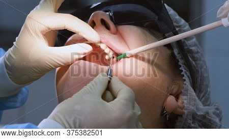 Oral surgeon shows installed dental implant into senior woman gum and jaw bone. Dentist and assistant work with a patient in modern dental clinic