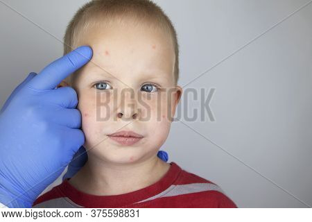 An Allergist Or Dermatologist Examines Red Spots On A Child’s Face. The Boy Suffers From A Rash, Hiv