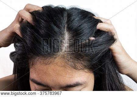 Women Head With Dandruff Caused By The Problem Of Dirty. Or Caused By Skin Disease Or Seborrheic Der