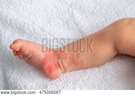 Infant Hemangioma Red Birthmark On The Leg Of Newborn Baby