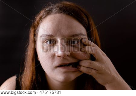 Freaky Ill Woman Pulling Skin Of Face To Side By Fingers. Pain, Ugliness Over Face. Mentally Unhealt
