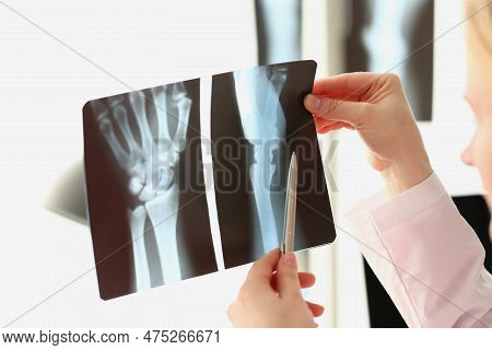 Female Doctor Looks At X-ray Of A Arm Injury In Hospital. Sequelae Of Hand Injuries And Arthritis