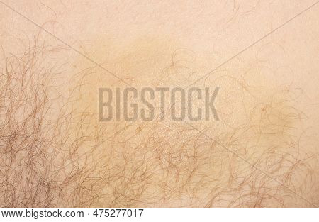 A Bruise On The Body From A Traumatica Pistol.a Hematoma From A Blow.bruise Background.the Bruise Is