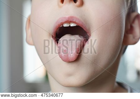 Kyiv, Ukraine - April, 26, 2023:  White Spots On The Tongue. Oral Thrush Is A Fungal Infection That 