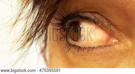 A Nice Brown Chestnut Eye Of A Mediterranean Latin Woman, Showing A  Conjunctival Stromal Degenerati