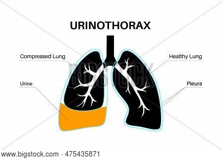 Urinothorax Disease. Urine Collects In Fluid-filled Cavity In Lungs. Chest Pain, Difficulty Breathin