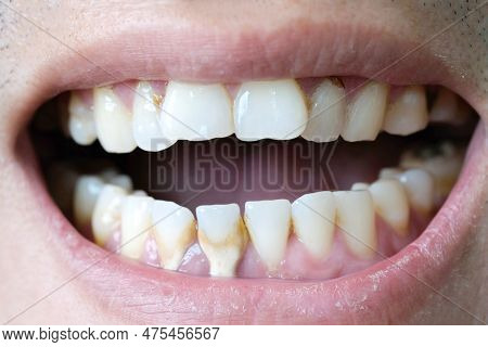 Tooth's A Man Smoking Bad. Man Smokes A Cigarettes Have Tooth Decay And Calculus On Teeth, So We Sho